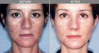 Chicago Laser Skin Tightening